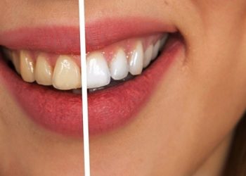 Three Common Dental Procedures to Fix Your Smile