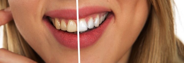Three Common Dental Procedures to Fix Your Smile