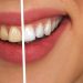 Three Common Dental Procedures to Fix Your Smile