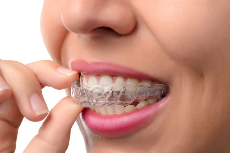 IS INVISALIGN EXPENSIVE?