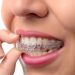 IS INVISALIGN EXPENSIVE?