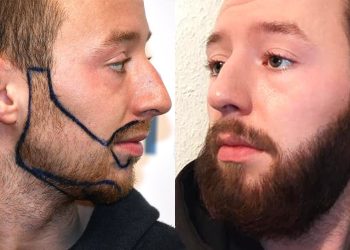 The Science Behind Beard Transplants