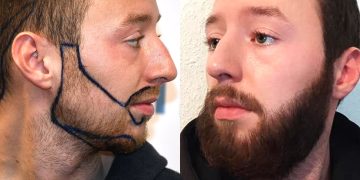 The Science Behind Beard Transplants