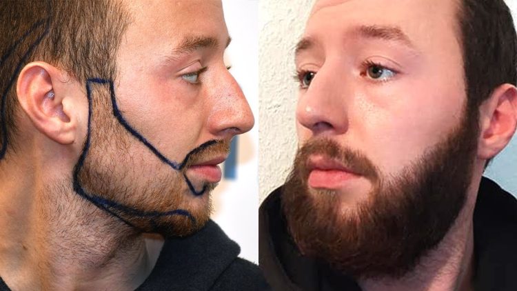 The Science Behind Beard Transplants